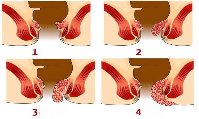 nolakoak diren hemorroideak fase desberdinetan